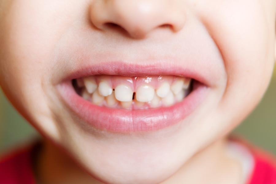 小児矯正・咬合育成